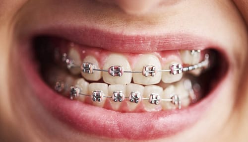 Shot of child's teeth with braces